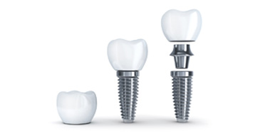implante-dentario-orthoclinica-dentista-sbc-abc