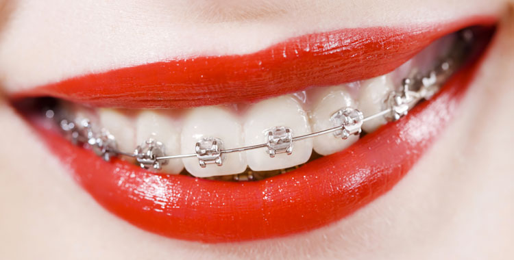 Aparelho fixo ortodôntico dentário de safira - transparente 
