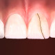 dente-quebrado-fraturado-orthoclinica-dentista-sbc-abc