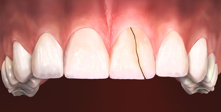 dente-quebrado-fraturado-orthoclinica-dentista-sbc-abc