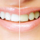 clareamento dental-orthoclinica-dentista-sbc-abc