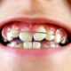 Aparelho-Dentario-Conteudo-atualizado-para-Voce---Orthoclinica