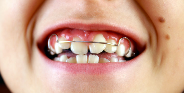 Aparelho-Dentario-Conteudo-atualizado-para-Voce---Orthoclinica