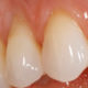 a-retracao-da-gengiva-tem-cura-orthoclinica-dentista-sbc-abc