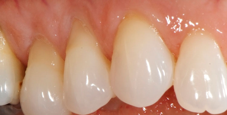 a-retracao-da-gengiva-tem-cura-orthoclinica-dentista-sbc-abc