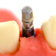 implante-dentario-dicas-basicas-para-um-bom-pos-operatorio-orthoclinica.jpg