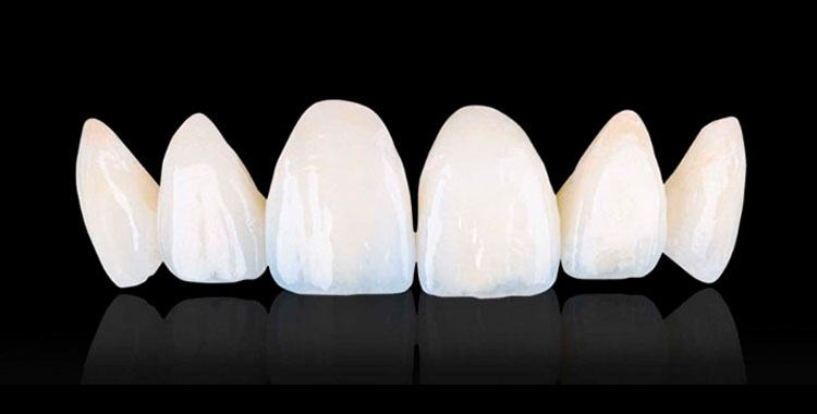 faceta-de-porcelana-sorriso-bonito-orthoclinica-dentista-sbc-abc