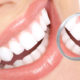 lente-de-contato-dental-o-segredo-do-sorriso-perfeito-OrthoClinica