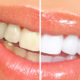 clareamento-Dental-5-coisas-que-voce-precisa-saber-hoje