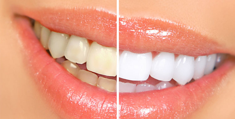 clareamento-Dental-5-coisas-que-voce-precisa-saber-hoje